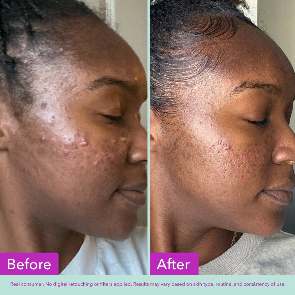 acne-foaming-cleanser-s9 zb_p.jpg